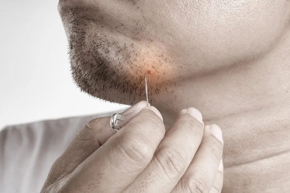 Asian,Man,Picking,Ingrown,Facial,Hair,With,Clip,Needle